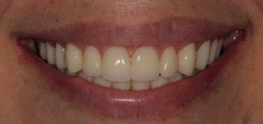 Young With Partial Dentures Ashford AL 36312